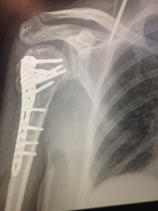 x-ray, pins, broken arm
